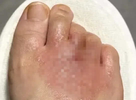 脚上不明小水疱，教你一眼分清湿疹与脚气，不再用错药
